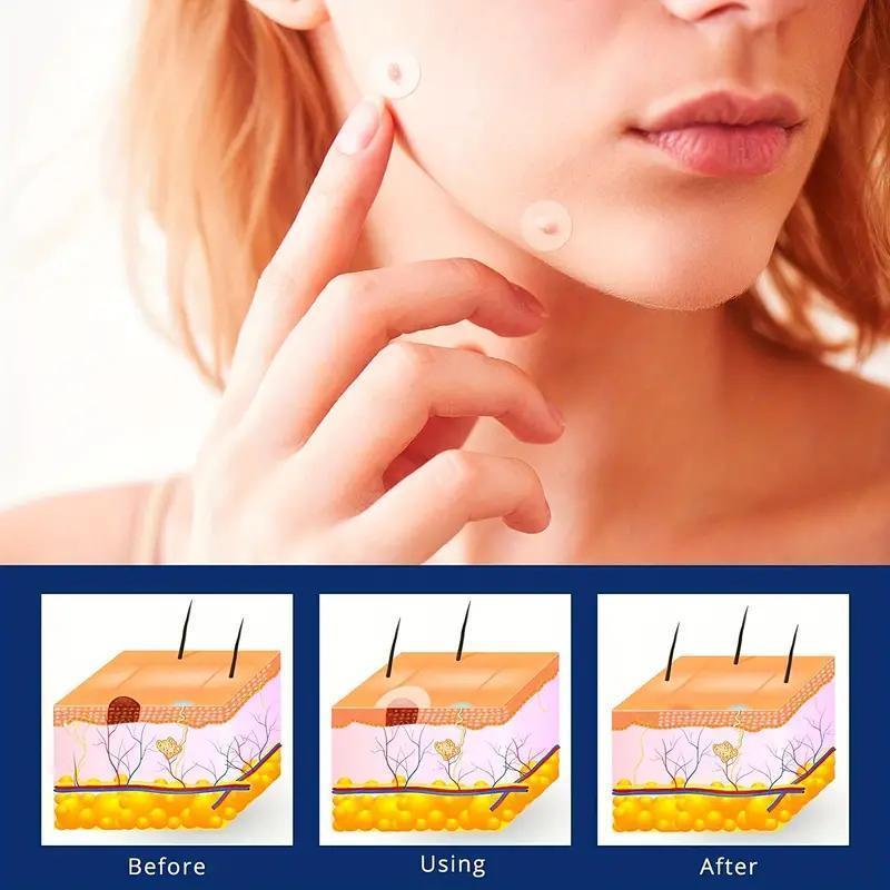 Skin Tag Cover Patches, 2 Boxes Acne Pimple Patch for Covering Zits and Blemishes, Mole & Wart Remover, Skin Care Product, Christmas Gift