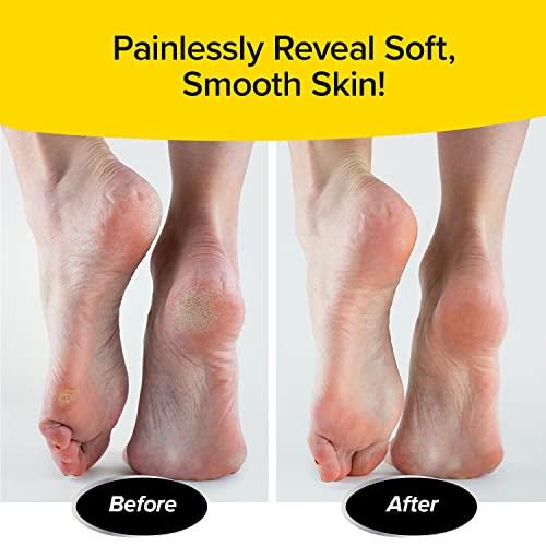 PedEgg Jumbo As Seen On TV, Gently Removes Calluses & Dry Skin Without Bending for Smooth, Soft Feet, Easy Reach Handle, Mess-Free, 300% More Microfiles Than Original, Reach Your Feet with Ease