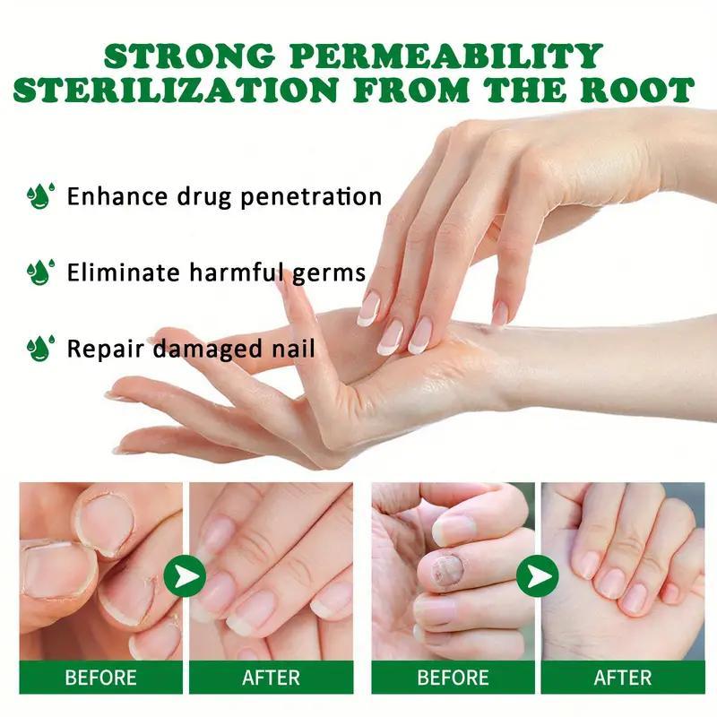 [Free Shipping]Ginger Nail Treatment Nail Support Nail Care