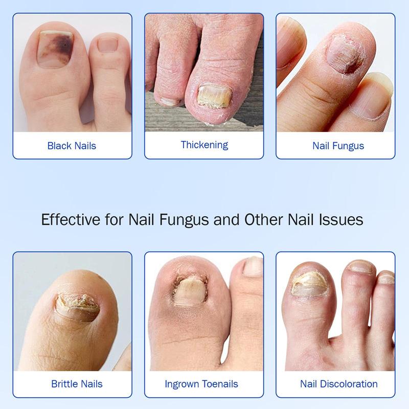 Fungal Nail Patches, 2 Boxes Nail Health Care Patches, Nail Care Patches, Suitable for Solving Fungal Nails and Other Nail Problems