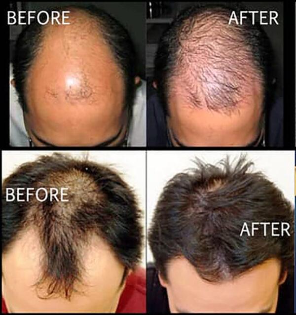 3 MONTHS KIRKLAND MINOXIDIL 5% MENS HAIR LOSS REGROWTH GENERIC TREATMENT Gentle Hair Care Gentle Hair Care