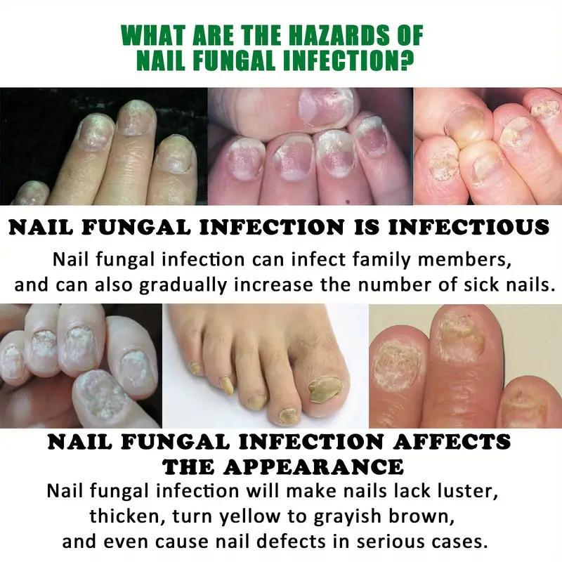 (Free Shipping) JAYSUING Ginger Nail Treatment Support Nail Care with Vitamin E and Plant Essential Oils- toes  nail paronychia beriberi Onychomycosis Nail deformation. Comfort Nail Polish Manicure Nail Art