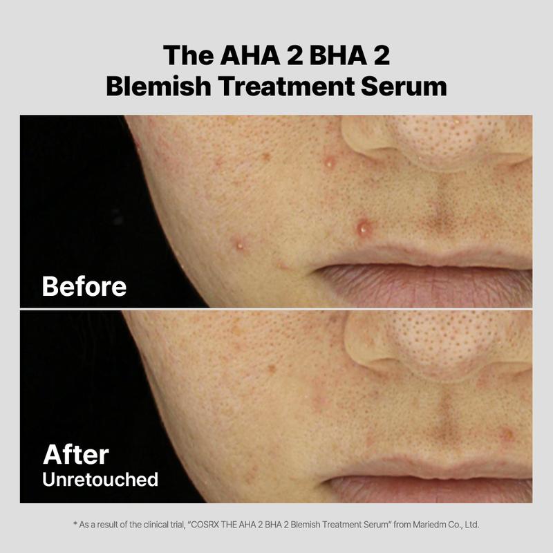 [COSRX OFFICIAL] The AHA 2 BHA 2 Blemish Treatment Serum (30+ cotton balls per serum) | Breakout Spot Treatment, Pore Care, Blemish Care