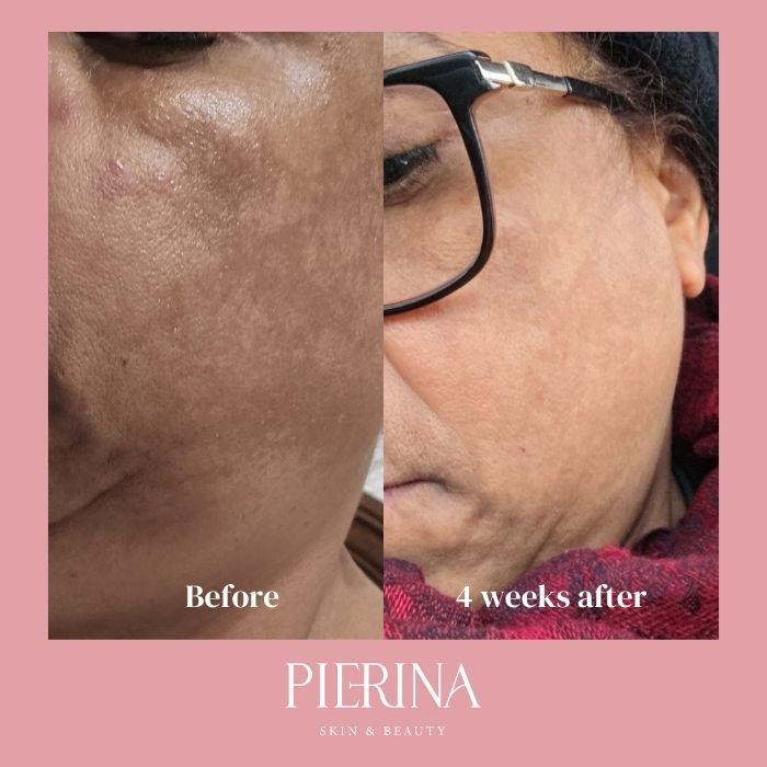 Anti-Melasma Even Skin System