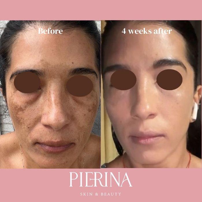 Anti-Melasma Even Skin System